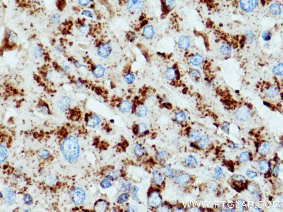 IHC staining of human liver cancer using 67300-1-Ig (same clone as 67300-1-PBS)