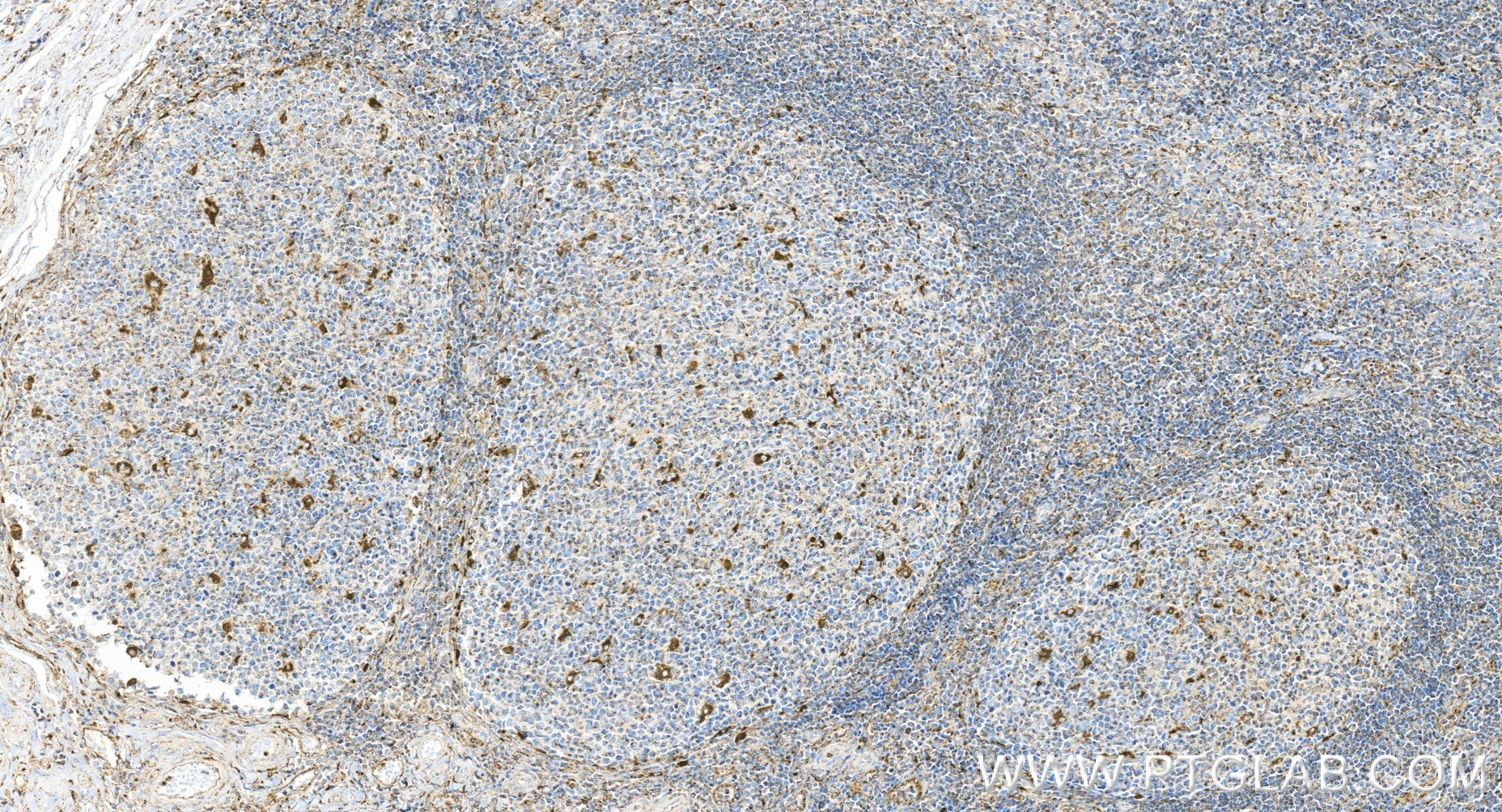 IHC staining of human tonsillitis using 98266-2-RR