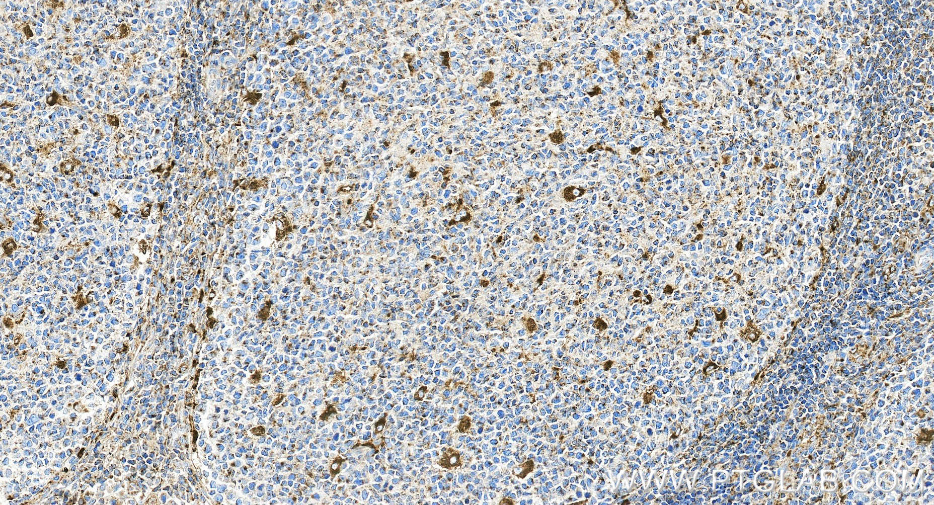 IHC staining of human tonsillitis using 98266-2-RR