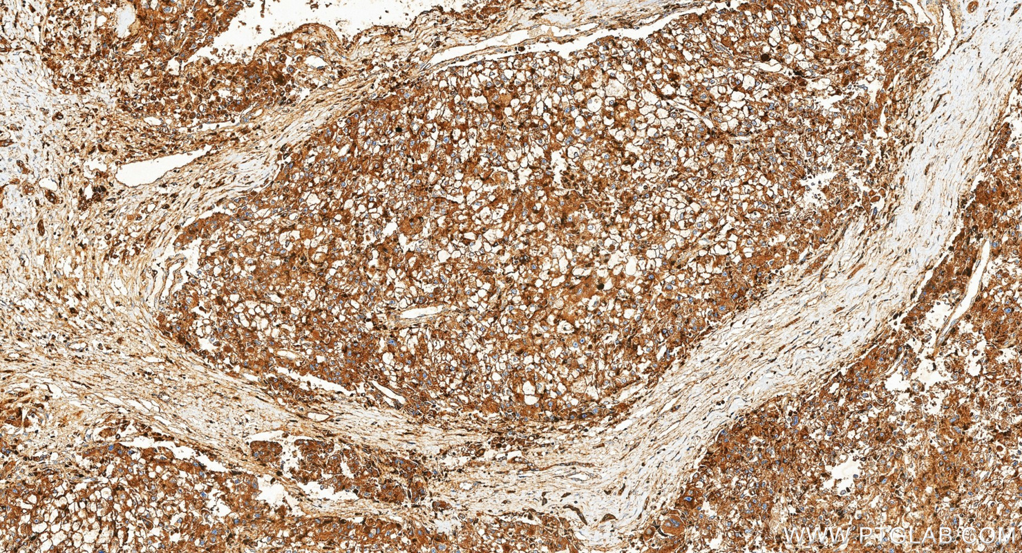 IHC staining of human liver cancer using 34523-1-AP