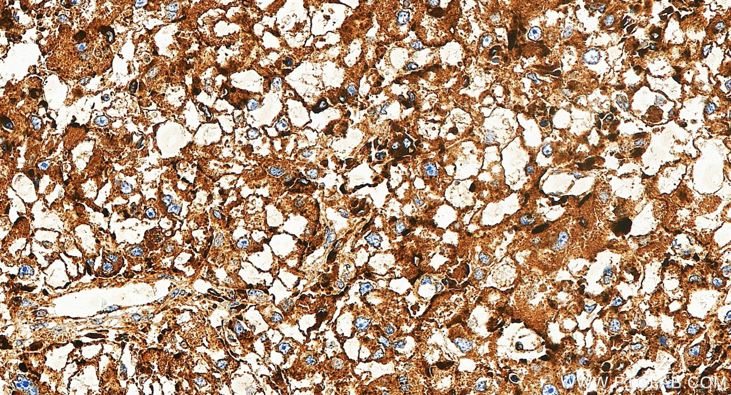 IHC staining of human liver cancer using 34523-1-AP