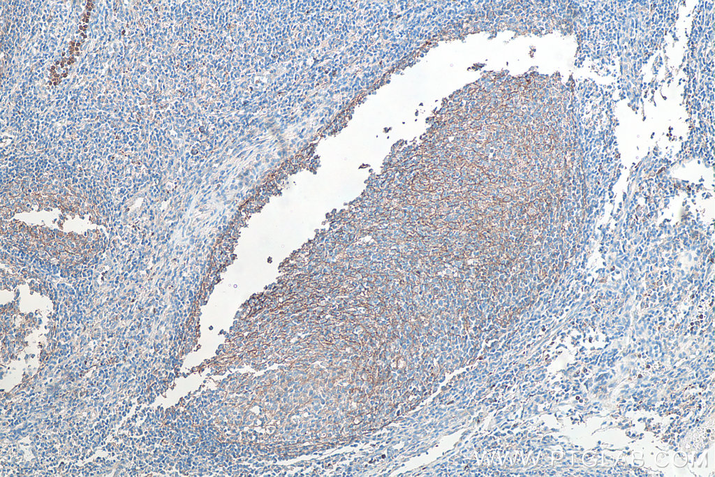IHC staining of human tonsillitis using 66519-1-Ig