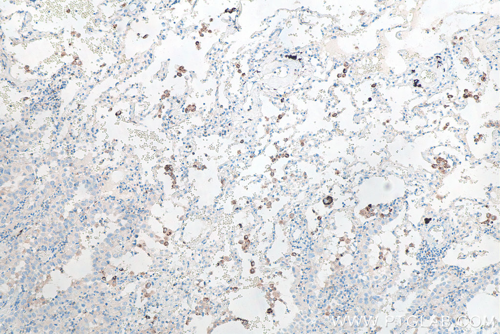 IHC staining of human lung cancer using 66519-1-Ig