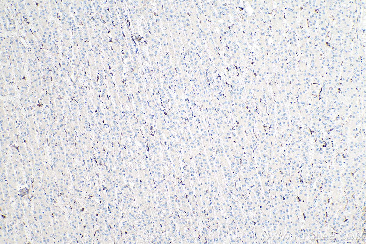 IHC staining of human liver cancer using 66519-1-Ig
