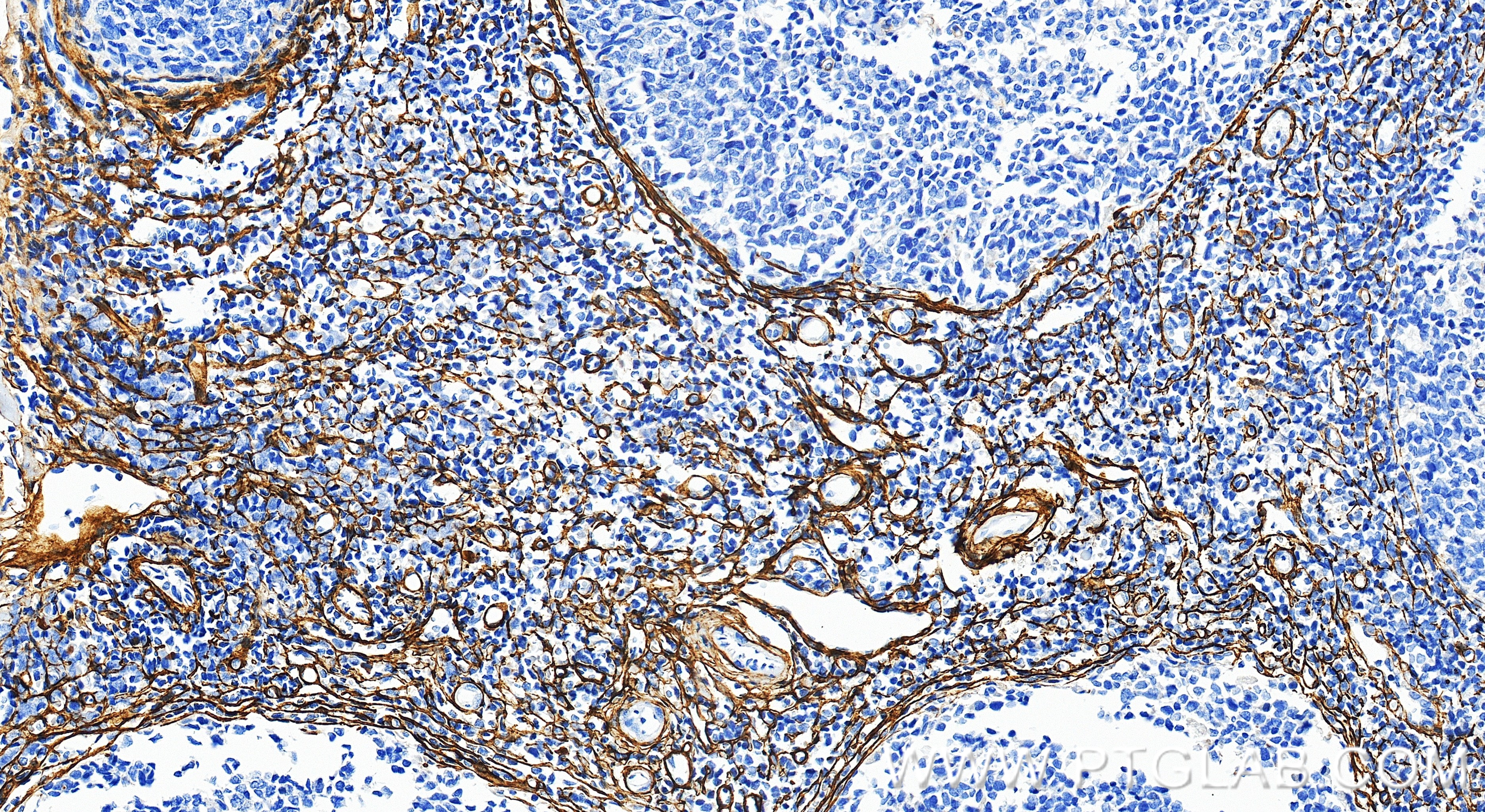 IHC staining of human tonsillitis using 87542-1-RR