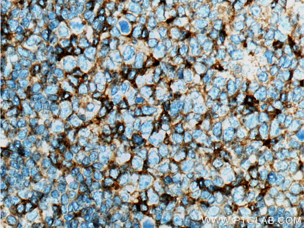 IHC staining of human tonsillitis using 66256-1-Ig