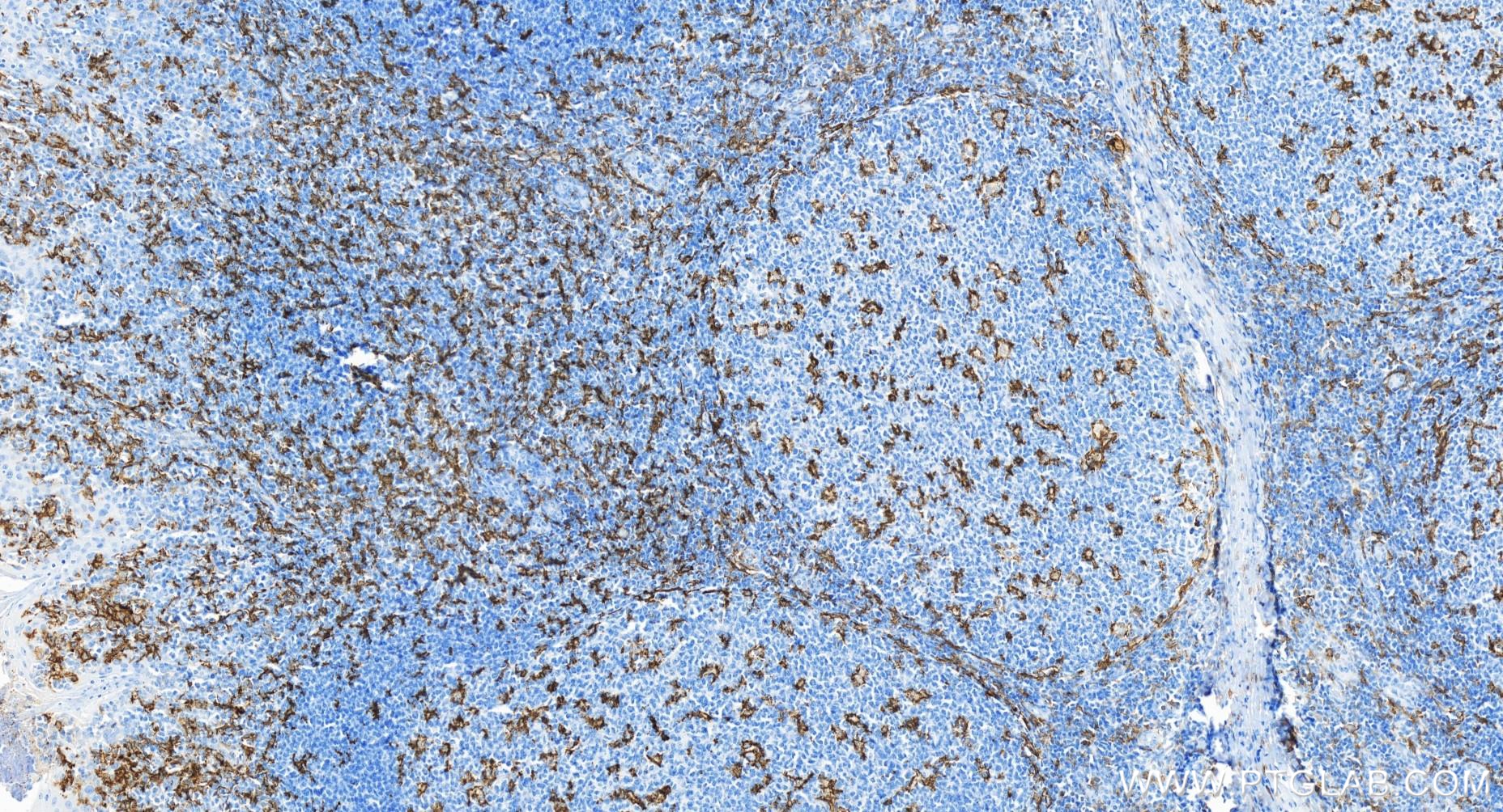 IHC staining of human tonsillitis using 81853-1-RR