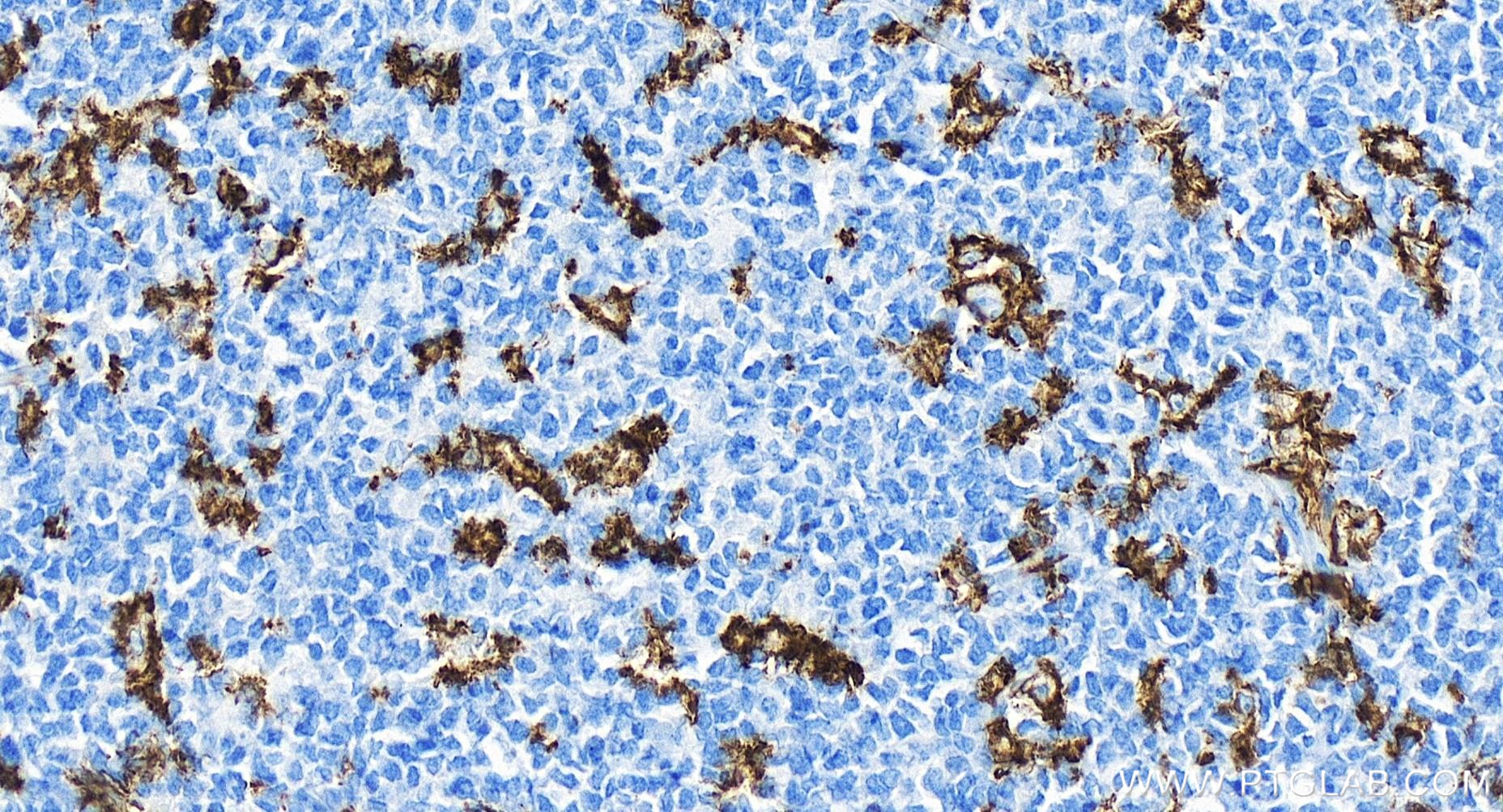 IHC staining of human tonsillitis using 81853-1-RR