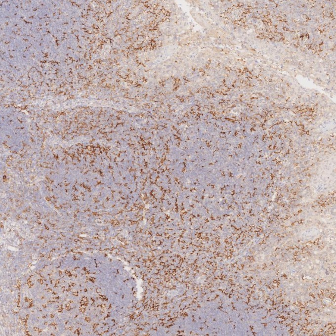 IHC staining of human tonsillitis using 81853-1-RR IHC staining of human tonsillitis using 81853-1-RR