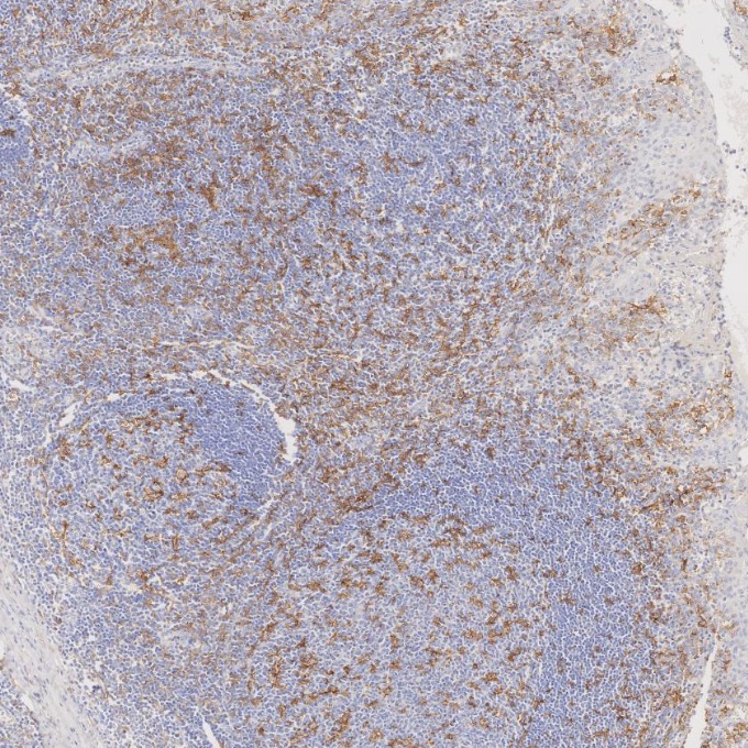 IHC staining of human tonsillitis using 81853-1-RR IHC staining of human tonsillitis using 81853-1-RR
