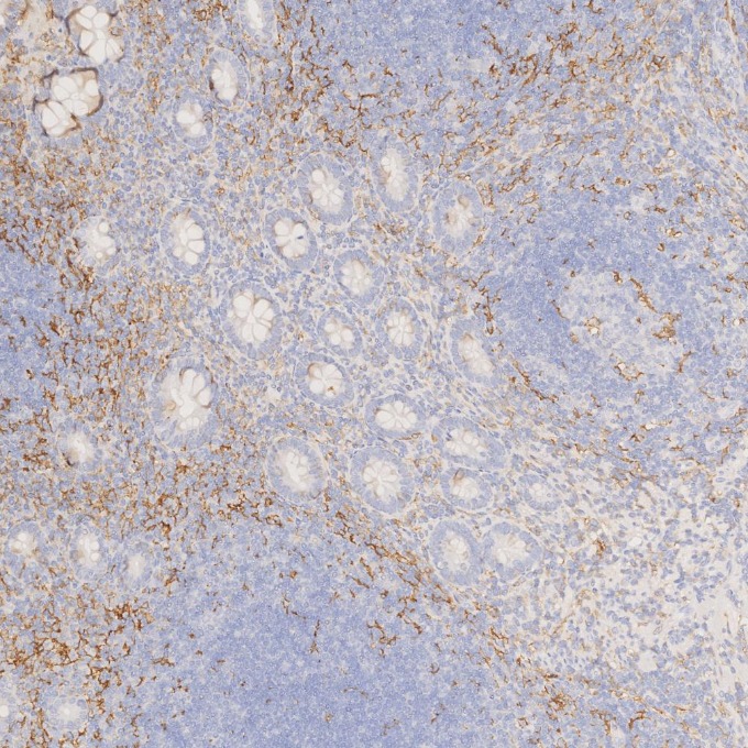 IHC staining of human appendicitis using 81853-1-RR IHC staining of human appendicitis using 81853-1-RR