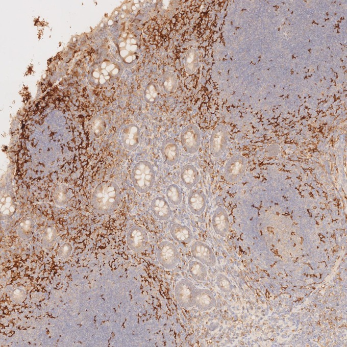 IHC staining of human appendicitis using 81853-1-RR IHC staining of human appendicitis using 81853-1-RR