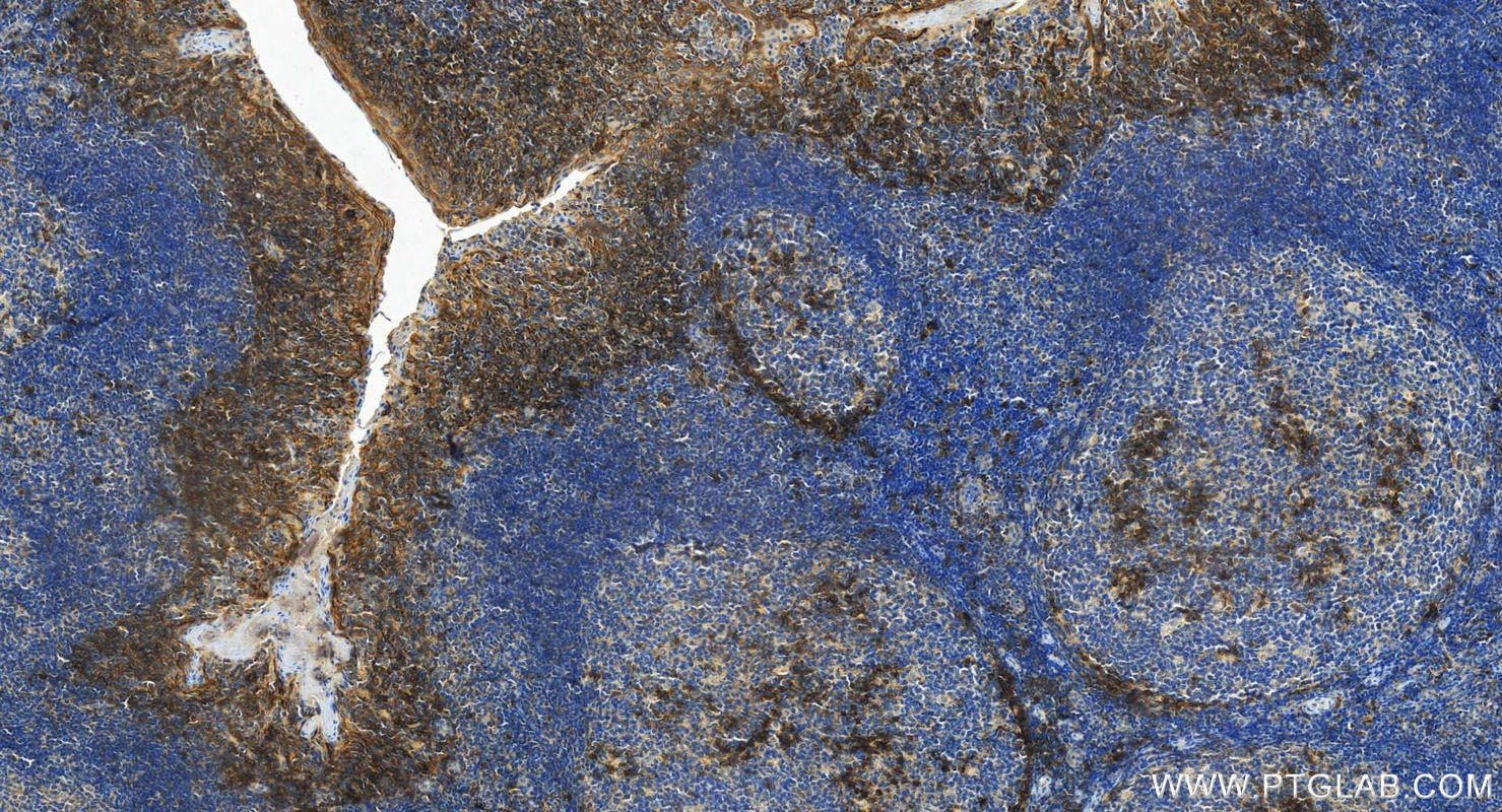 IHC staining of human tonsillitis using 31341-1-AP