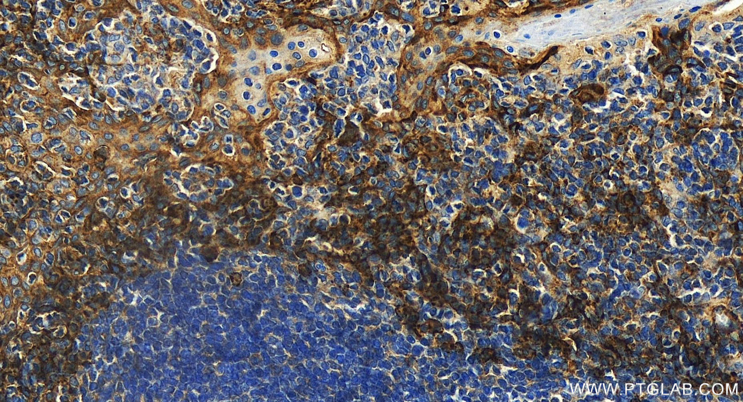 IHC staining of human tonsillitis using 31341-1-AP