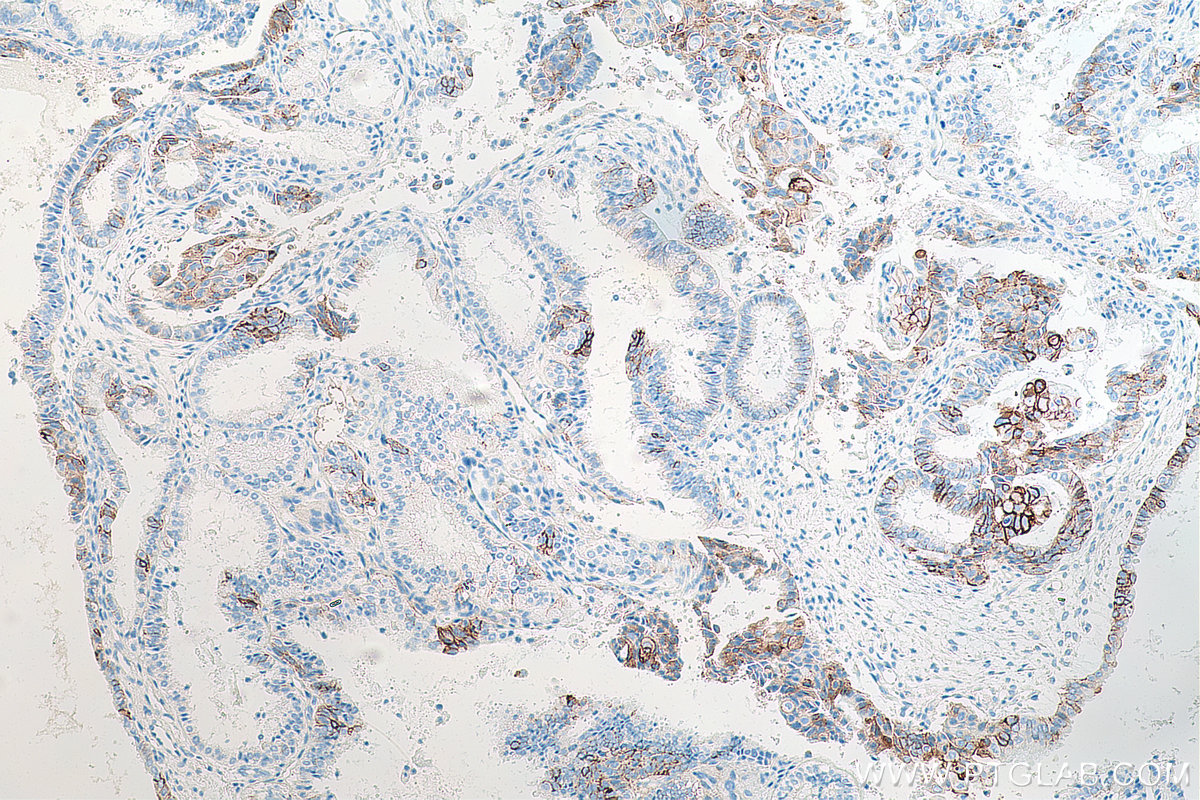 IHC staining of human ovary tumor using 67155-1-Ig IHC staining of human ovary tumor using 67155-1-Ig