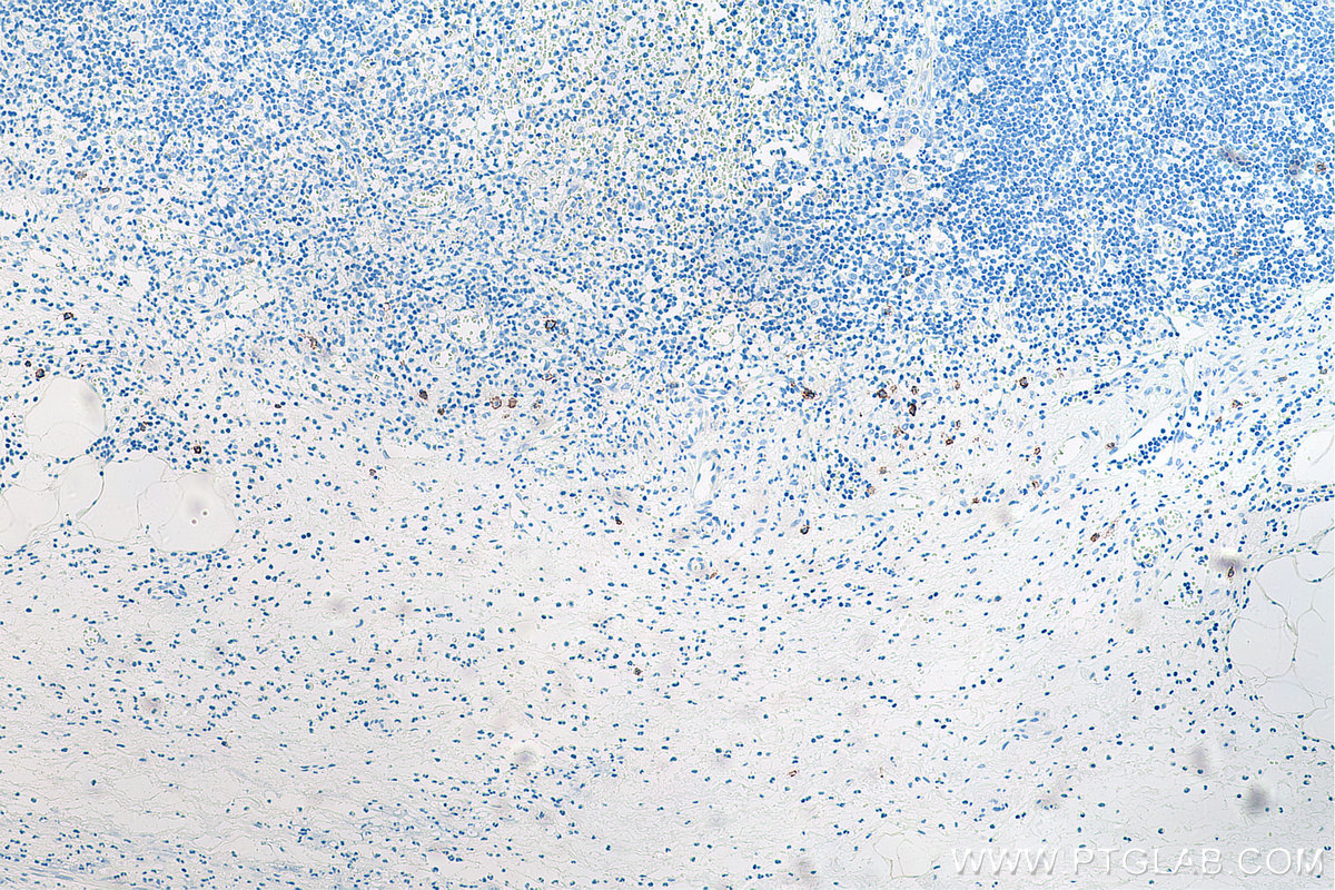 IHC staining of human appendicitis using 67155-1-Ig IHC staining of human appendicitis using 67155-1-Ig