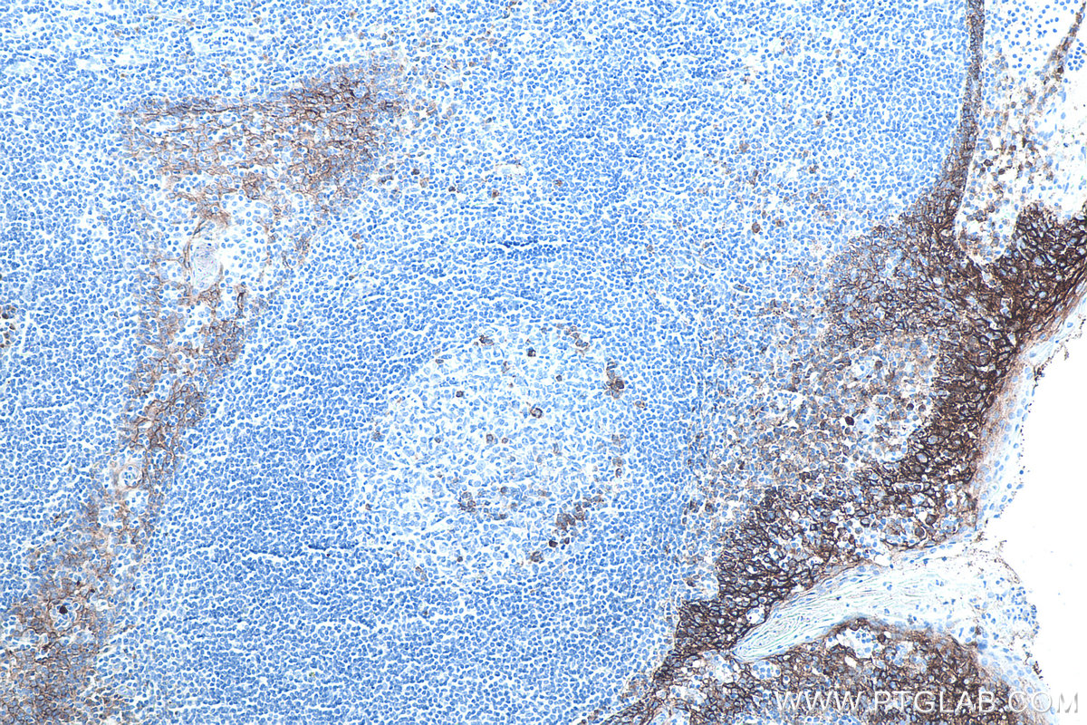 IHC staining of human tonsillitis using 67155-1-Ig IHC staining of human tonsillitis using 67155-1-Ig