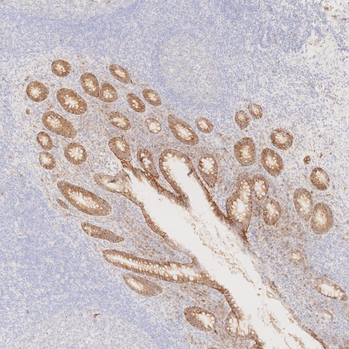 IHC staining of human appendicitis using 67155-1-Ig