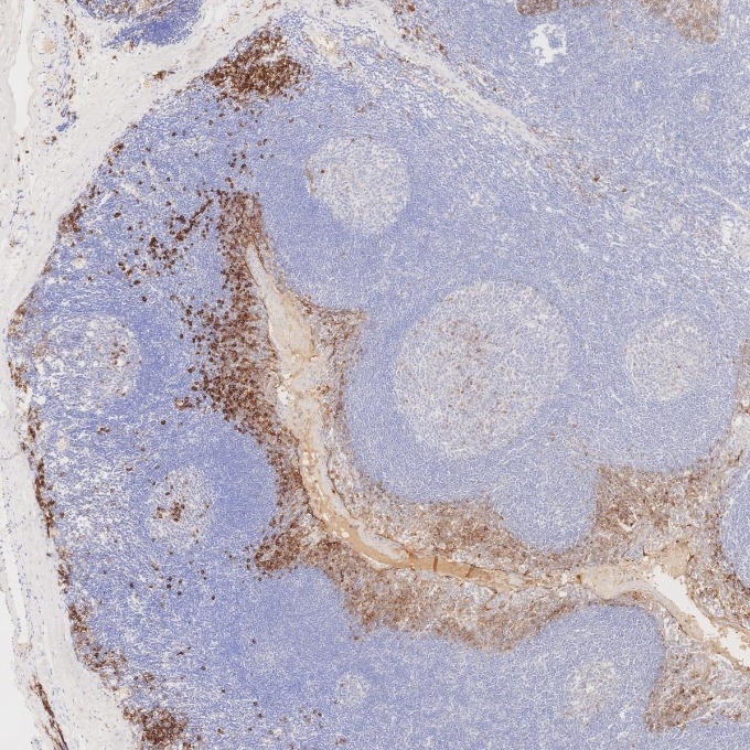 IHC staining of human tonsillitis using 67155-1-Ig