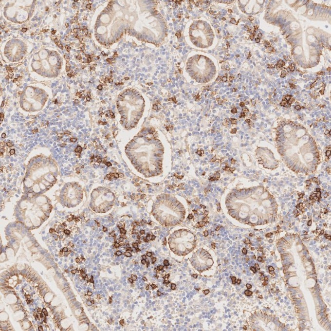 IHC staining of human lymphoma using 67155-1-Ig