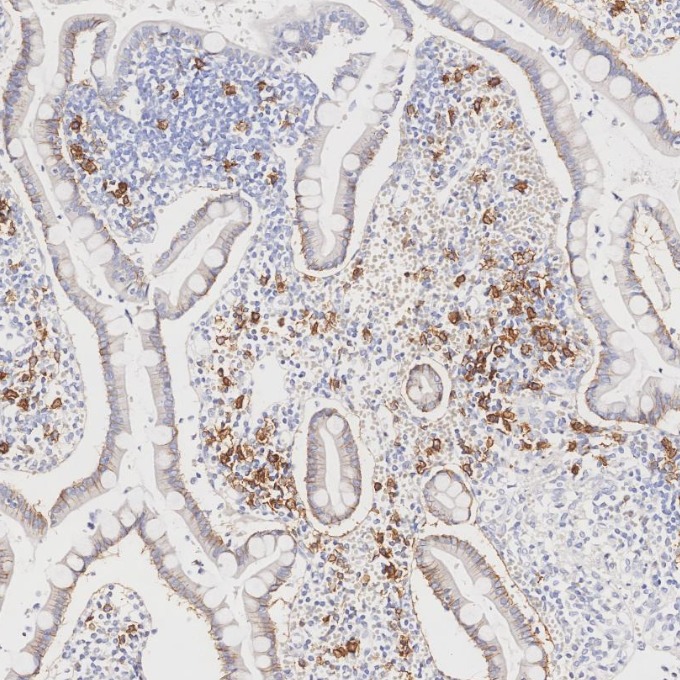 IHC staining of human lymphoma using 67155-1-Ig