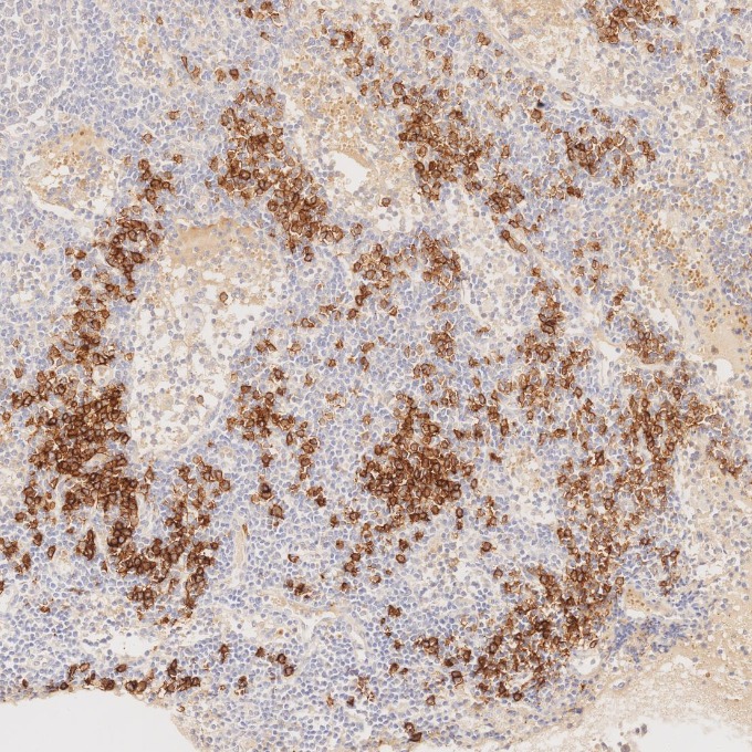 IHC staining of human lymphoma using 67155-1-Ig