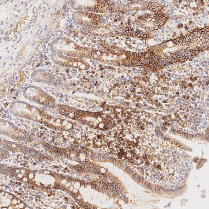 IHC staining of human lymphoma using 67155-1-Ig