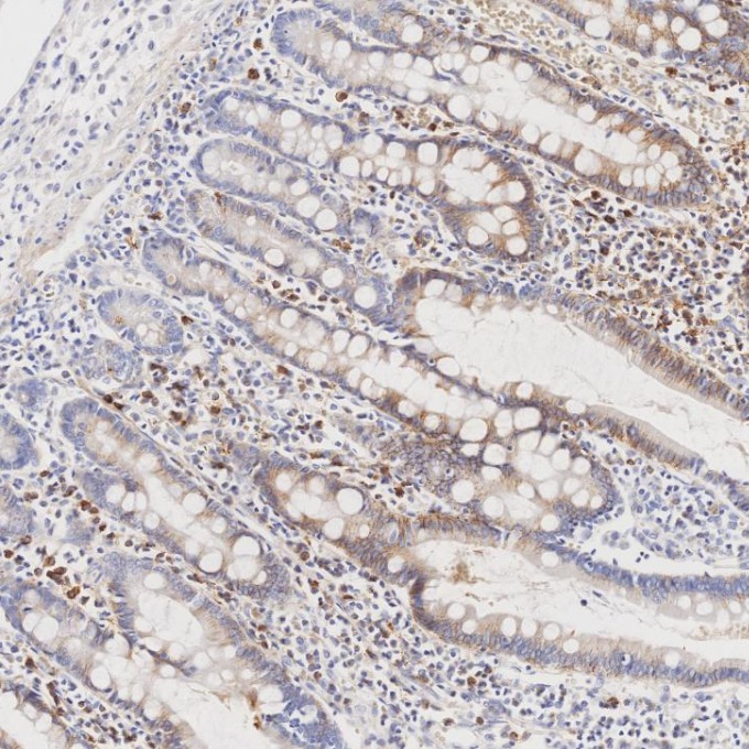 IHC staining of human lymphoma using 67155-1-Ig