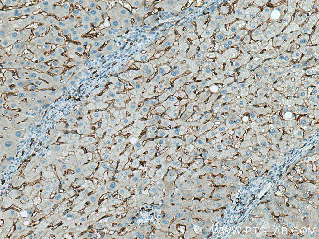 IHC staining of human hepatocirrhosis using 17000-1-AP