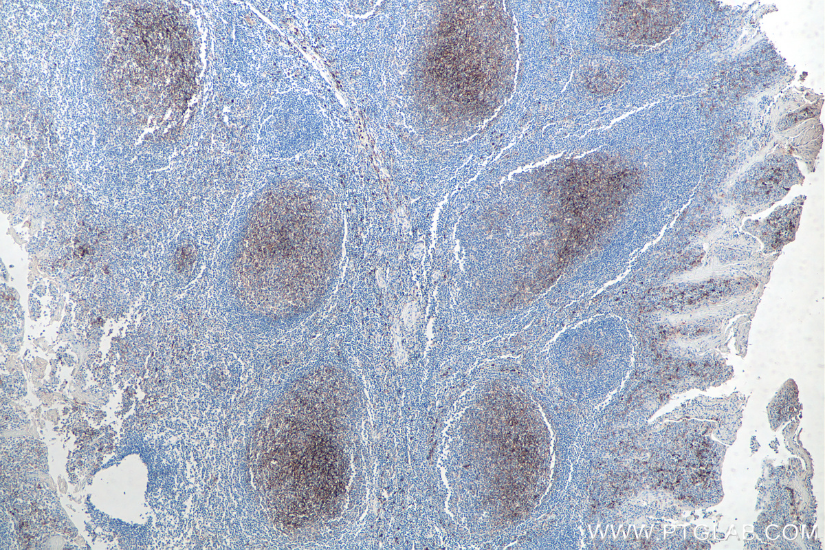 IHC staining of human tonsillitis using 60253-1-Ig