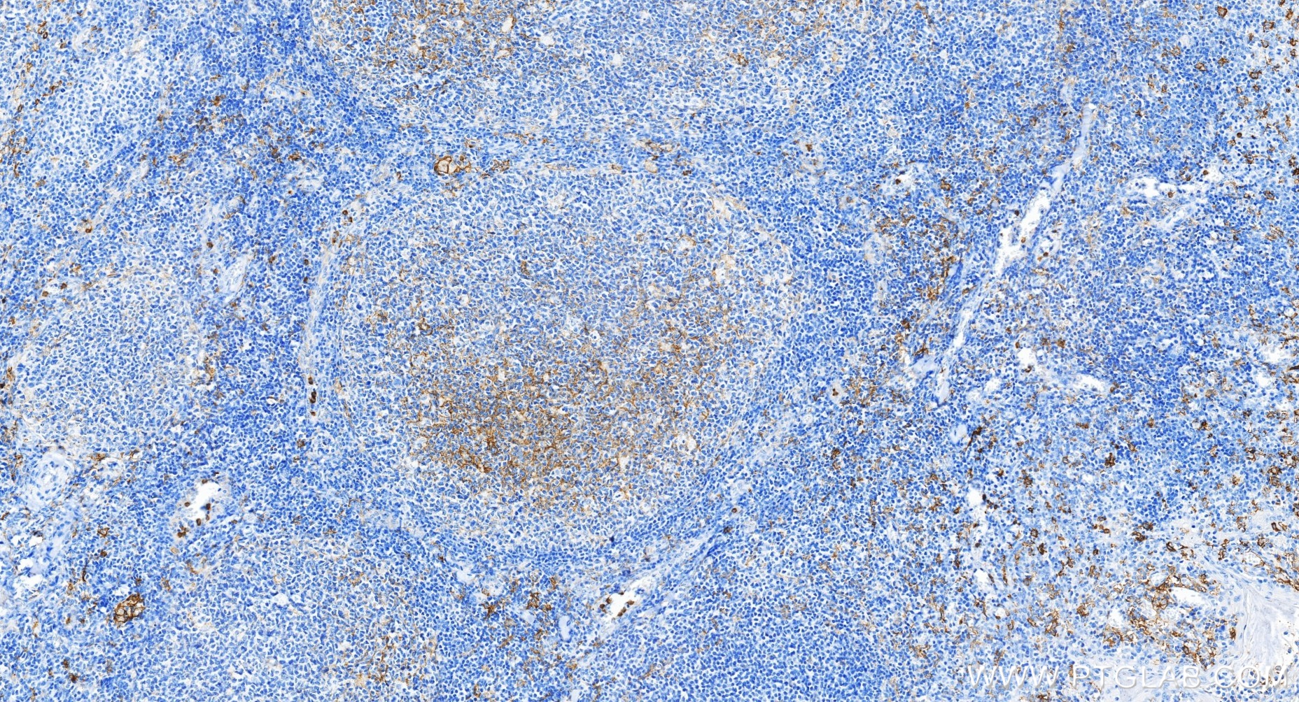 Immunohistochemical analysis of paraffin-embedded human tonsillitis tissue slide using <a class='green' href='/productredirect?CatalogNo=83055-4-RR' target='_blank'>83055-4-RR</a> (CD14 antibody) at dilution of 1:20000 (under 20x lens). Heat mediated antigen retrieval with Tris-EDTA buffer (pH 9.0). This data was developed using the same antibody clone with 83055-4-PBS in a different storage buffer formulation. IHC staining of human tonsillitis using 83055-4-RR (same clone as 83055-4-PBS)
