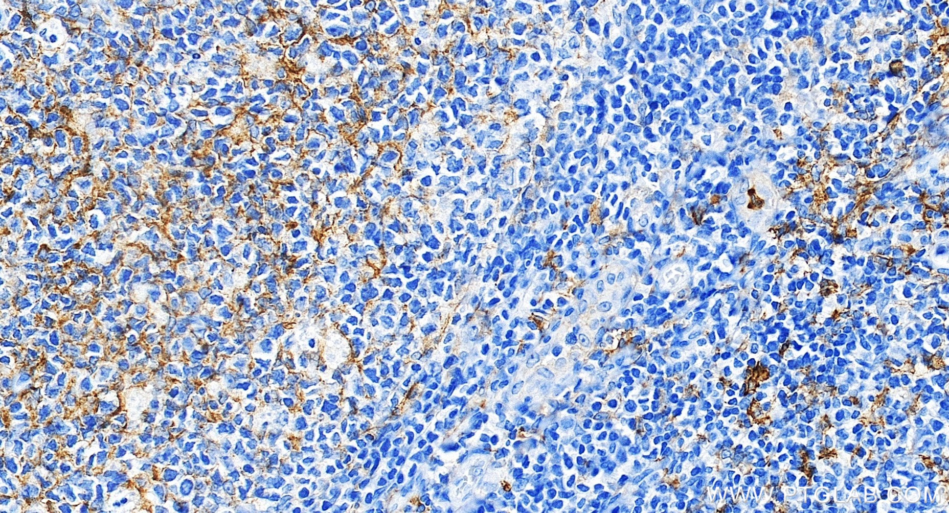 Immunohistochemical analysis of paraffin-embedded human tonsillitis tissue slide using <a class='green' href='/productredirect?CatalogNo=83055-4-RR' target='_blank'>83055-4-RR</a> (CD14 antibody) at dilution of 1:20000 (under 20x lens). Heat mediated antigen retrieval with Tris-EDTA buffer (pH 9.0). This data was developed using the same antibody clone with 83055-4-PBS in a different storage buffer formulation. IHC staining of human tonsillitis using 83055-4-RR (same clone as 83055-4-PBS)