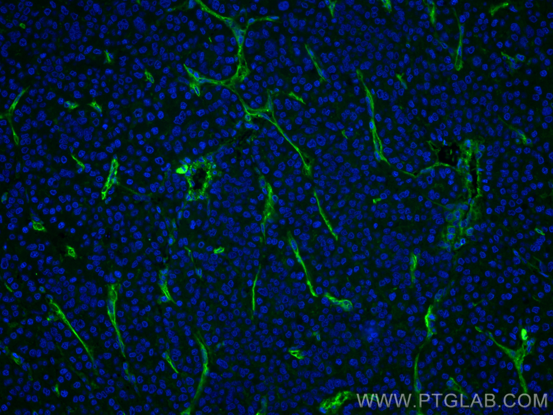 IF Staining of human liver cancer using 66153-1-Ig (same clone as 66153-1-PBS)