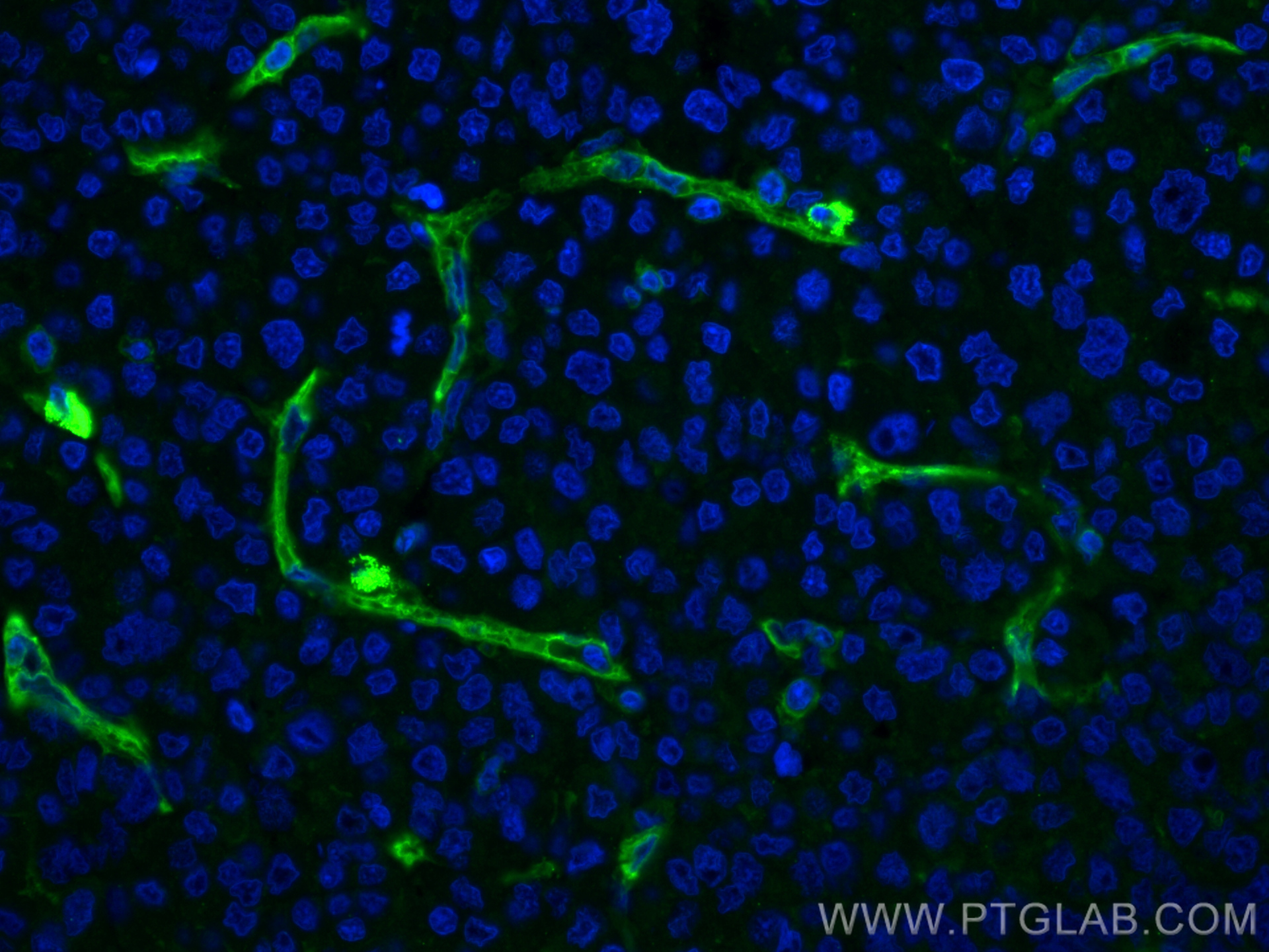 IF Staining of human liver cancer using 66153-1-Ig (same clone as 66153-1-PBS)