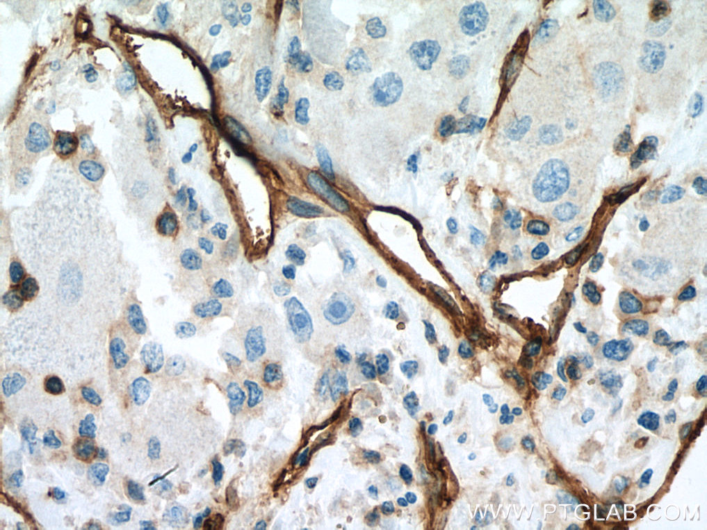 IHC staining of human liver cancer using 66153-1-Ig (same clone as 66153-1-PBS)
