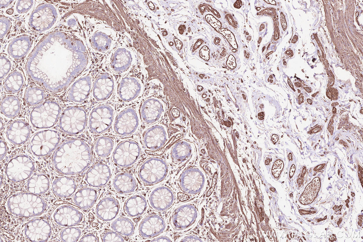 IHC staining of human rectal cancer using 66153-1-Ig
