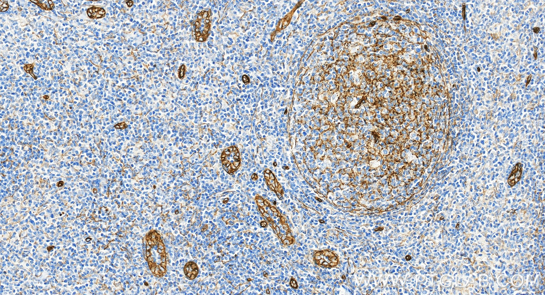 IHC staining of human tonsillitis using 86492-1-RR