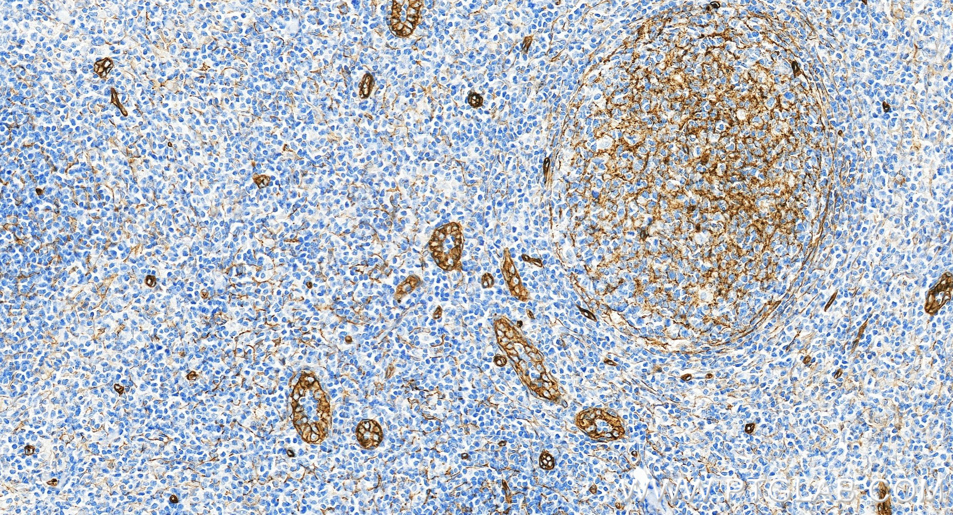 IHC staining of human tonsillitis using 98561-2-RR IHC staining of human tonsillitis using 98561-2-RR