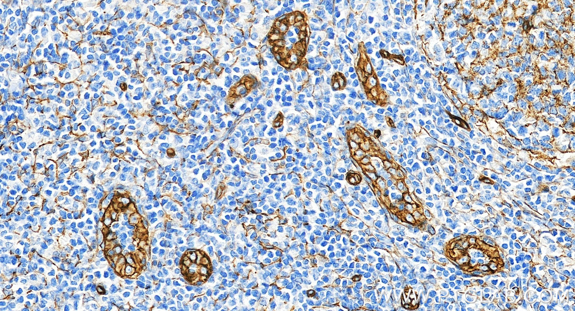 IHC staining of human tonsillitis using 98561-2-RR IHC staining of human tonsillitis using 98561-2-RR