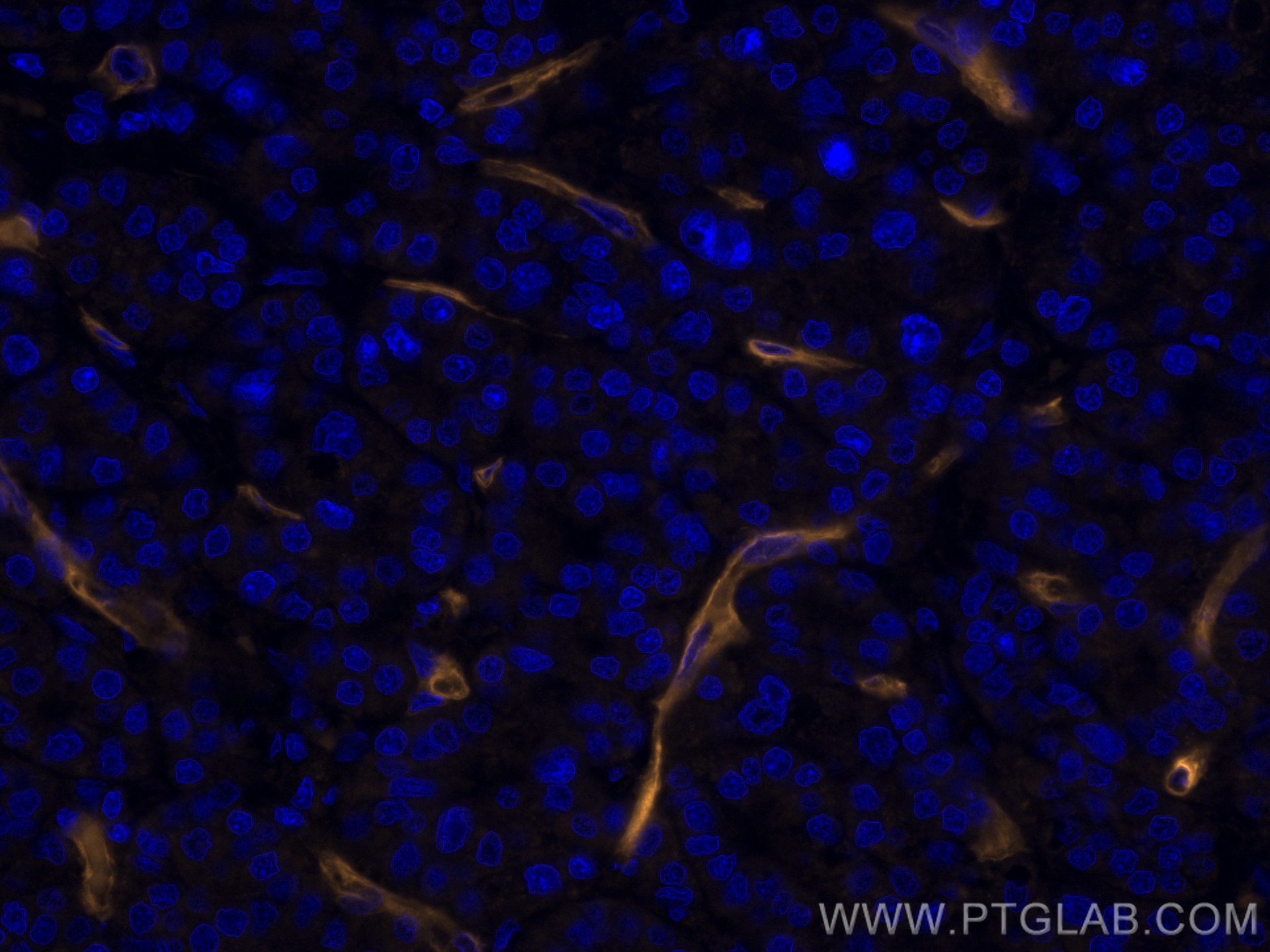 IF Staining of human liver cancer using CL555-66153