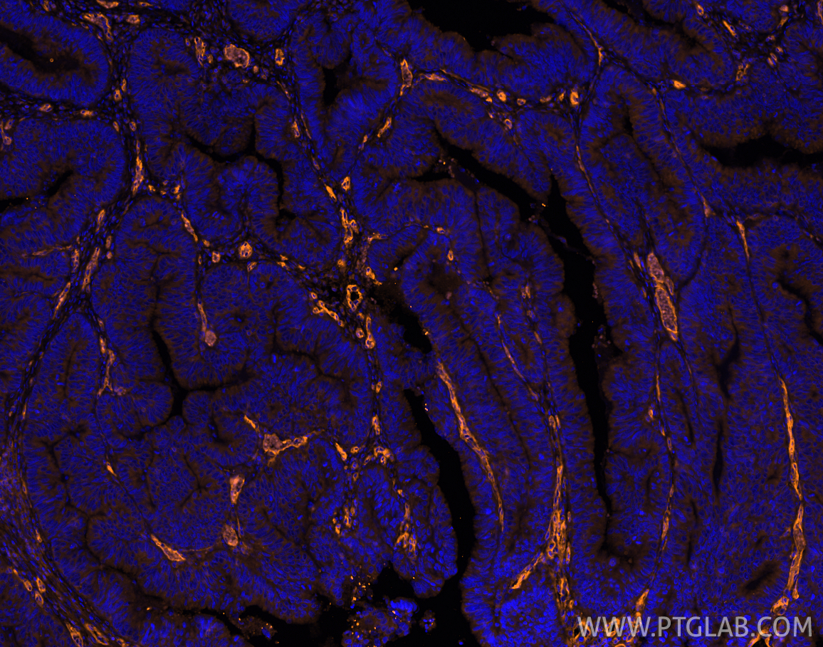 IF Staining of human colon cancer using PE-66153