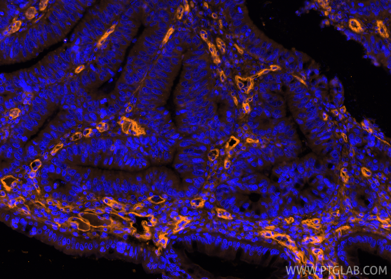 IF Staining of human colon cancer using PE-66153