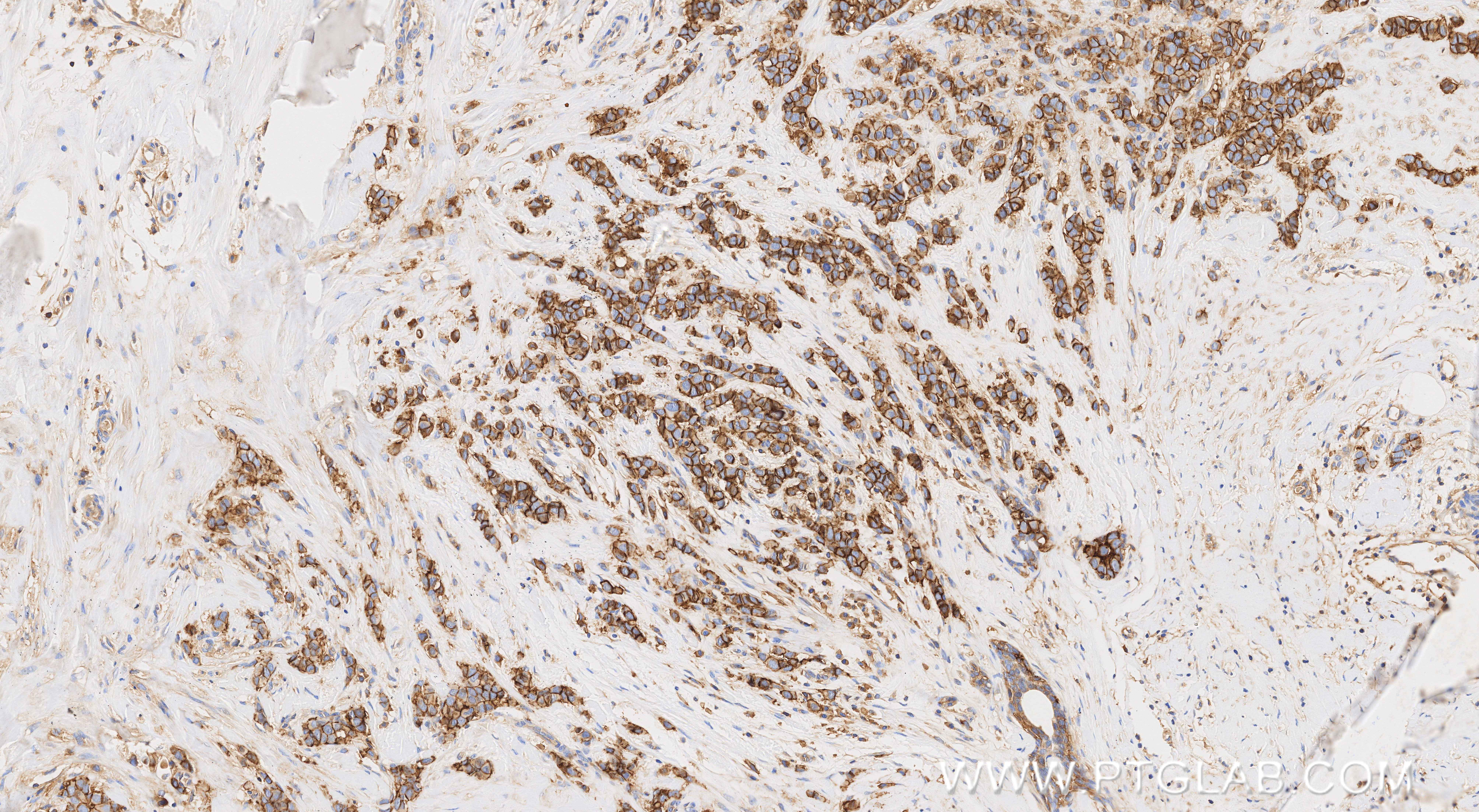 IHC staining of human breast cancer using 82909-8-RR
