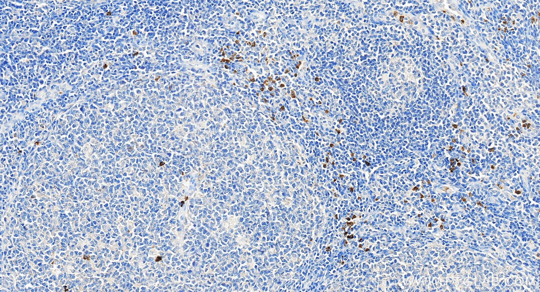 Immunohistochemical analysis of paraffin-embedded human tonsillitis tissue slide using <a class='green' href='/productredirect?CatalogNo=98616-1-RR' target='_blank'>98616-1-RR</a> (CD15 antibody) at dilution of 1:200 (under 20x lens). Heat mediated antigen retrieval with Tris-EDTA buffer (pH 9.0). This data was developed using the same antibody clone with 98616-1-PBS in a different storage buffer formulation. IHC staining of human tonsillitis using 98616-1-RR (same clone as 98616-1-PBS)