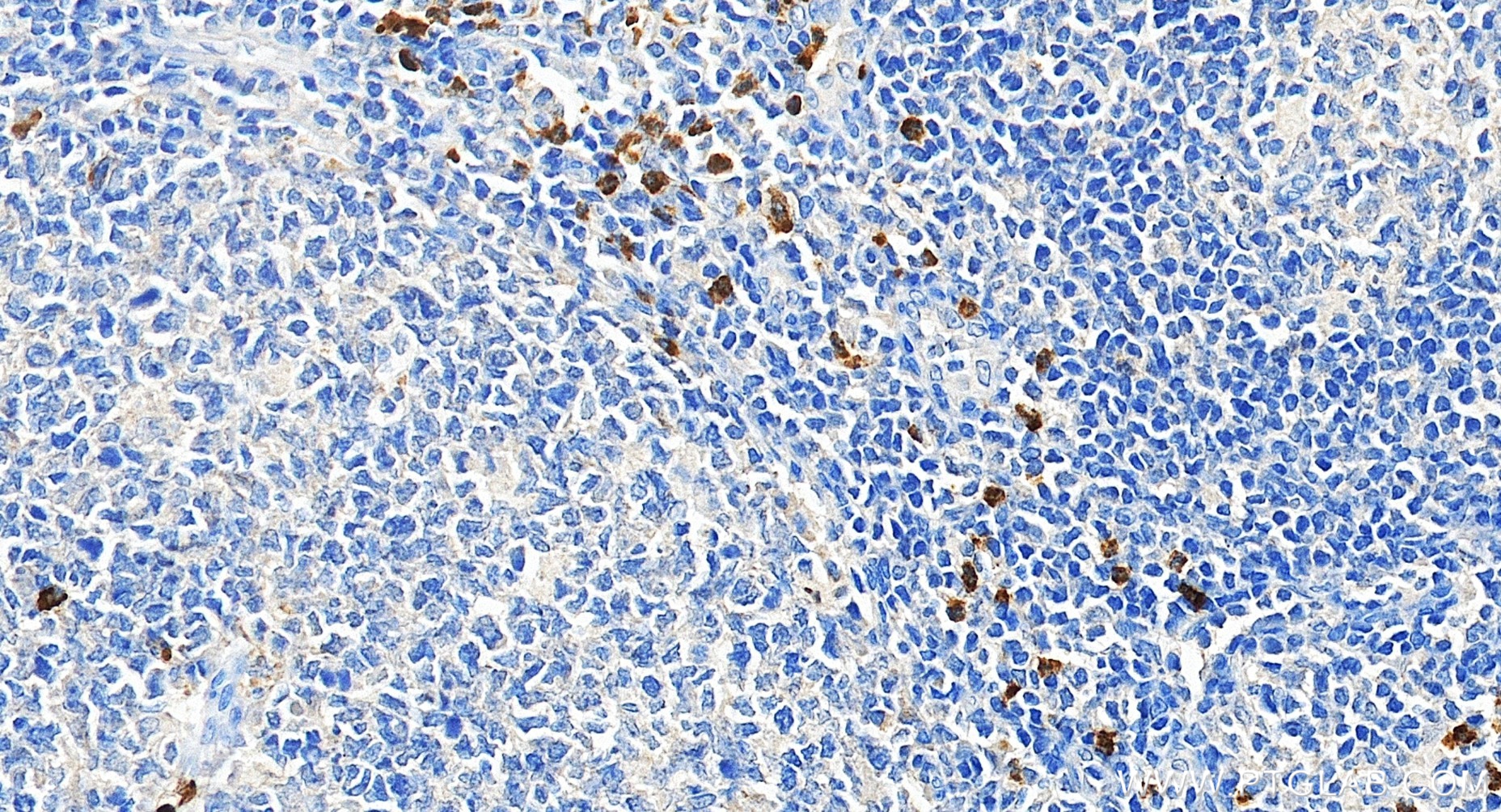 Immunohistochemical analysis of paraffin-embedded human tonsillitis tissue slide using <a class='green' href='/productredirect?CatalogNo=98616-1-RR' target='_blank'>98616-1-RR</a> (CD15 antibody) at dilution of 1:200 (under 40x lens). Heat mediated antigen retrieval with Tris-EDTA buffer (pH 9.0). This data was developed using the same antibody clone with 98616-1-PBS in a different storage buffer formulation. IHC staining of human tonsillitis using 98616-1-RR (same clone as 98616-1-PBS)