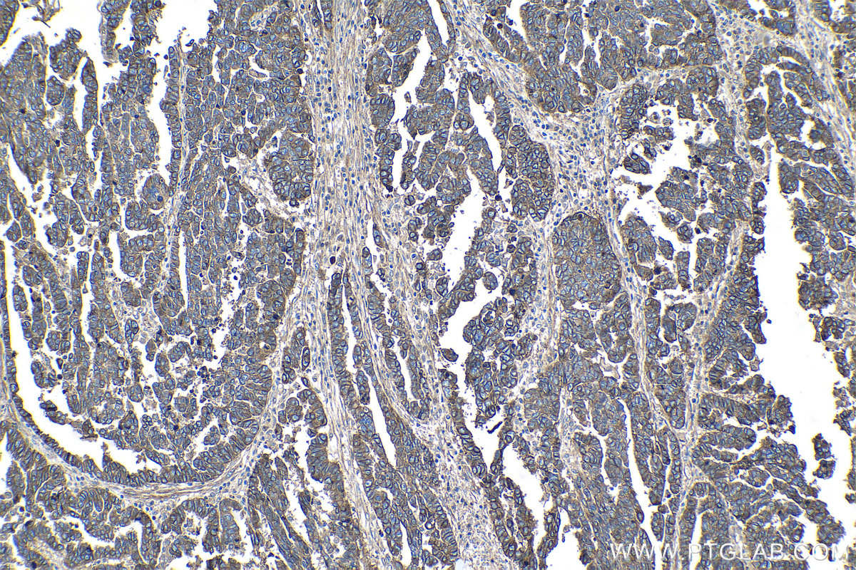 IHC staining of human ovary tumor using 27816-1-AP