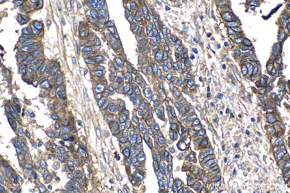 IHC staining of human ovary tumor using 27816-1-AP