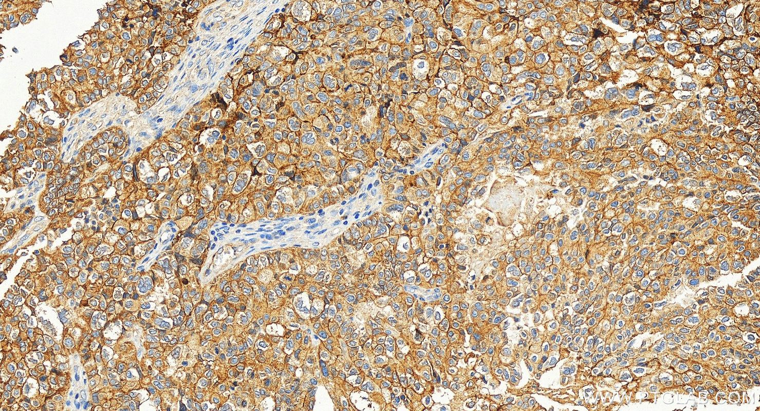 IHC staining of human ovary tumor using 27816-1-AP (same clone as 27816-1-PBS)
