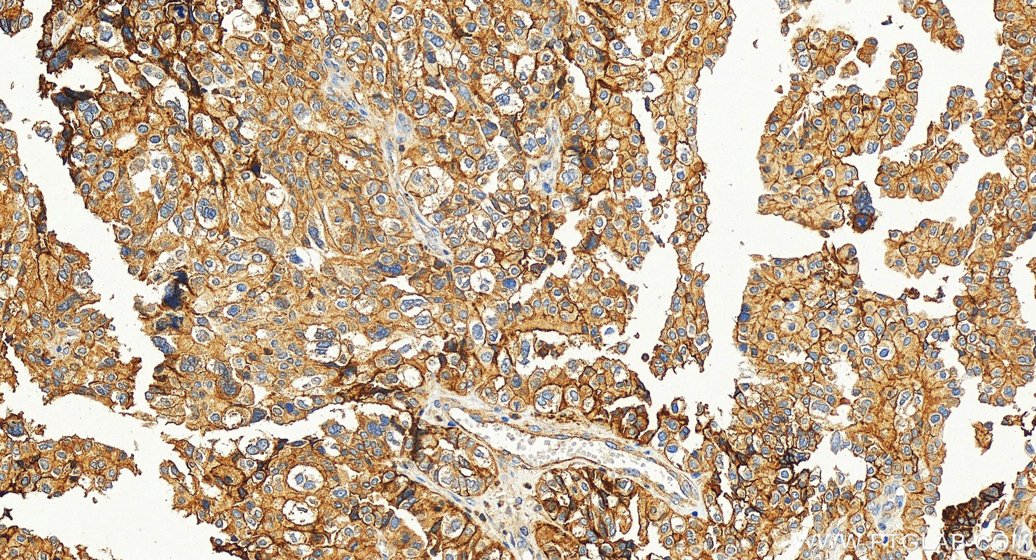 IHC staining of human ovary tumor using 27816-1-AP (same clone as 27816-1-PBS)