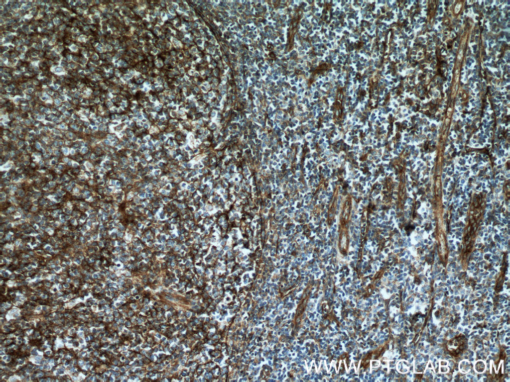 IHC staining of human tonsillitis using 66567-1-Ig (same clone as 66567-1-PBS)